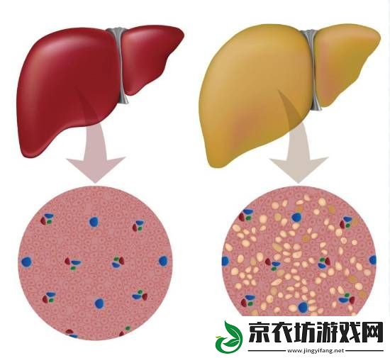 大学生月瘦20斤却患上脂肪肝